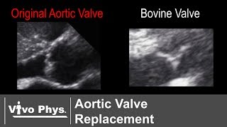 Pre Post Aortic Valve Replacement Surgery with a Bovine Valve [upl. by Ethelind]