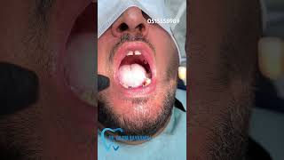 İmplant Diş Zirkon Metalokeramika dentist google baki qasimbayramov [upl. by Besnard]