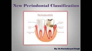 New Periodontal Classification [upl. by Gianina]