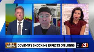 COVID19 Effects on Lungs with Dr Quan [upl. by Mattah280]