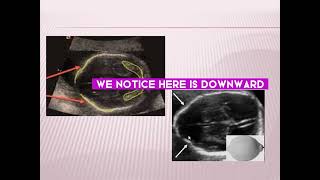 Ultrasonographic diagnosis of fetal spina bivida [upl. by Airret]