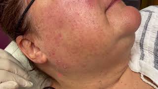 Removing Solar Lentignos amp Seborrheic Keratosis SKs with Lasers [upl. by Enorahs]