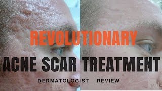 Acne scar treatments 2018 UPDATE [upl. by Leoni]