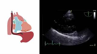 Mastering important TEE views transesophageal echocardiography [upl. by Halilad756]