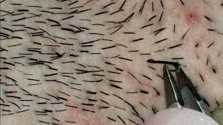 Plucking THICK Beard Hairs Gross and Satisfying [upl. by Dragelin]