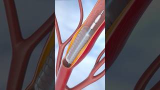 Coronary Angioplasty and Stent Insertion coronary angioplasty [upl. by Jehias134]