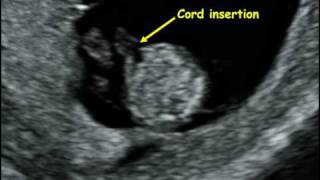 Fetal Medicine Foundation  Fetal anatomy 12 weeks [upl. by Alphard]