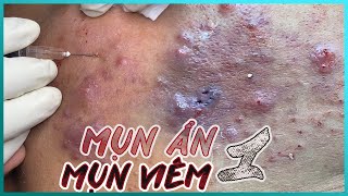 Big Cystic Acne Blackheads Extraction Blackheads amp Milia Whiteheads Removal Pimple Popping [upl. by Dnomsaj]