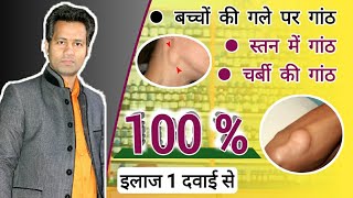 बच्चों के गले पर गांठ  Cervical Lymphnodes  Gale me gilti  Lipoma  Charbi ki ganth Fibroadenoma [upl. by Lila489]