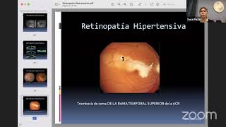 Clase de Retinopatia diabetica e hipertensiva 2022 [upl. by Cochran77]