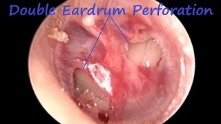 Double Tympanic Membrane  Eardrum  Perforation [upl. by Sixele452]