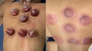 Best islamic hijama therapy in kolkata  Hijama cupping  kolkata [upl. by Eamon]