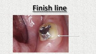 Fixed Prosthodontics 1  Lec 4  Finish Line [upl. by Hasseman250]