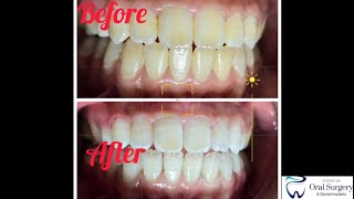 Amazing teeth whitening viralvideo [upl. by Adnof]