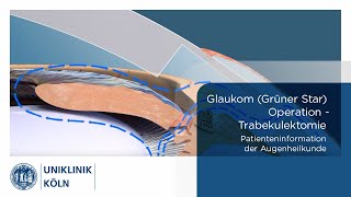 Glaukom Grüner Star OP  Trabekulektomie Patienteninformation Augenklinik  Uniklinik Köln [upl. by Sieracki]