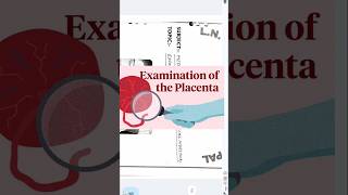 Placental examination demo fetal surface maternalumbilical cord examinationProcedure [upl. by Aliuqet]