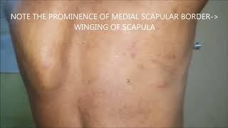 WINGING OF SCAPULA [upl. by Gretta324]