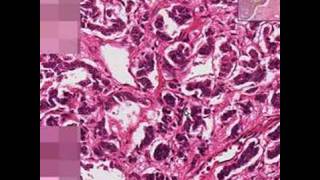 Histopathology LungBronchial carcinoid [upl. by Sternberg]