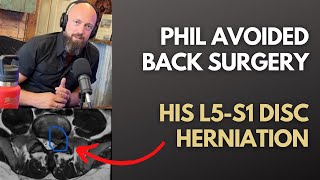 Phil Avoided Back Surgery L5S1 disc herniation Eliminates 90 of Pain in 8 Weeks of Limitless [upl. by Vlada]