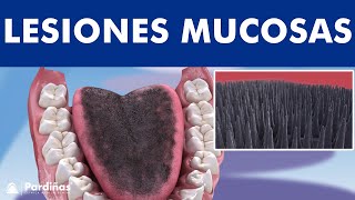 Lengua geográfica liquen plano leucoplasia y otras lesiones de mucosa oral © [upl. by Bergmans]