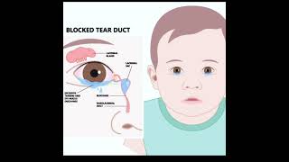 ជំងឺស្ទះរន្ធទឹកភ្នែក NasoLacrimal Duct ObstructionDacryostenosis [upl. by Joh]