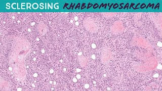 Sclerosing Rhabdomyosarcoma soft tissue pathology sarcoma [upl. by Nadnal]