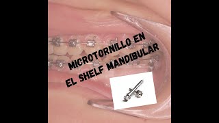 COLOCACION DE MICROTORNILLO EN SHELF MANDIBULAR [upl. by Dion13]