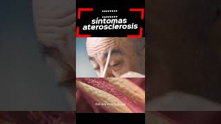 aterosclerosis síntomas aterosclerosis salud medicina [upl. by Aelhsa]