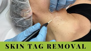 Skin Tags Removal on Neck and Underarms Quick easy no pain [upl. by Hakon726]