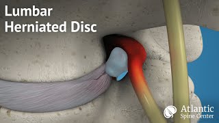 Lumbar Herniated Disc Overview [upl. by Dickenson115]