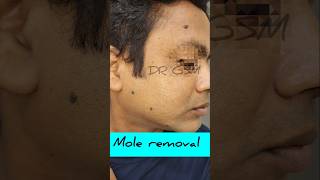 Mole removal drgsmukherjee moleremoval dermatologist laserclinic [upl. by Bradlee]