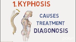 Kyphosis  Overview Causes Symptoms Treatment Diagnosis And Prevention  All in 2 min [upl. by Annabell]