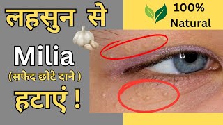 Milia Removal  आँखों के नीचे सफेद दाने हटाने का असान उपाय  Natural Home Remedy [upl. by Enad]