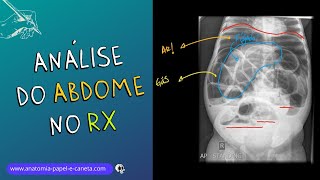 Aprenda a analisar o exame de ABDOME no RX [upl. by Nwahsal]