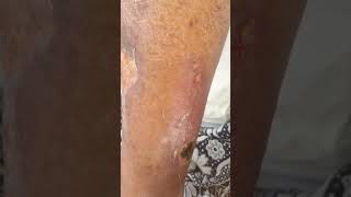 Cellulitis الالتهاب الخلوى [upl. by Donaldson485]