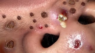 Blackhead Removal With Sac Dep Spa 100074089 [upl. by Euqinmod274]