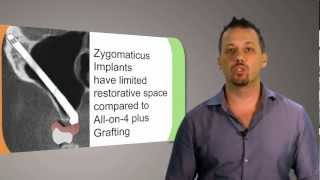 What are Zygomatic Implants AKA Zygoma  Cheekbone Implants  CAID Australia [upl. by Odelet516]