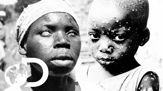 The Eradication Of Smallpox  Invisible Killers [upl. by Nirihs922]