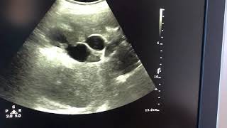 Dilated intrahepatic biliary radicles lab report is uploades in other video [upl. by Ecela]