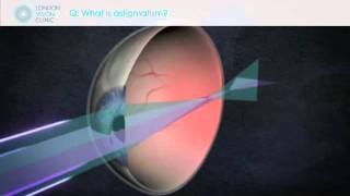 What is astigmatism [upl. by Otanod]