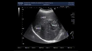 Ultrasound Video showing Hydatid Hepatic Cyst Cholelithiasis and Hepatic masses [upl. by Kironde260]