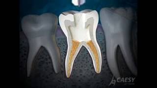 Pulpotomy Procedure  Walkthrough [upl. by Hsuk]