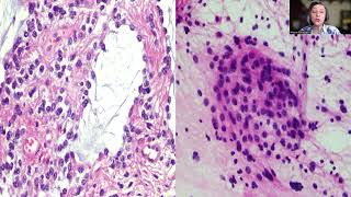 Tip31Pilocyticastrocytoma of an Adult [upl. by Gert412]