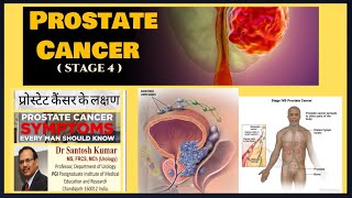 Prostate Cancer Stage 4 Prostate Cancer Metastatic Prostate Cancer DrProfSantosh Kumar PGI [upl. by Goodson204]