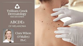 Learn the ABCDEs of Melanoma [upl. by Warp]