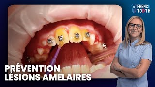 Prévention lésions amelaires en Orthodontie avec vernis fluoré Duraphat  Dr Médio [upl. by Maxentia]