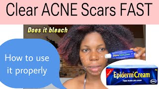 Get rid of Acne scars pimples  how to use epiderm cream properly answering questions [upl. by Hardan]