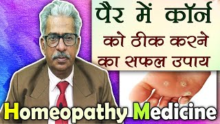 कॉर्न को कैसे ठीक करे  Corns Treatment  Dr PS Tiwari [upl. by Nadab]