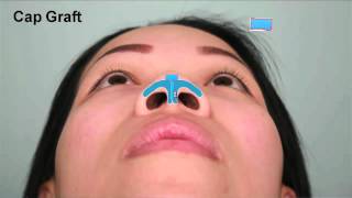 Asian Rhinoplasty Tip Augmentation Case Study Part 2  Dr Thomas Buonassisi 8 West Clinic in BC [upl. by Longo344]