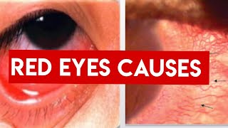 RED EYE  CAUSES  Conjunctivitis Vs Uveitis vs Acute angle closure Glaucoma [upl. by Aneehta]